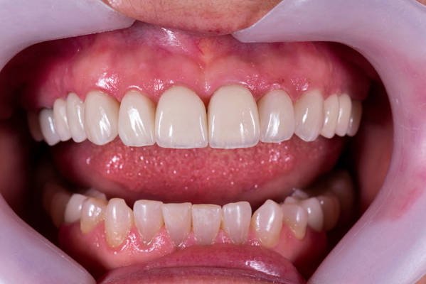 Do&#    ;s And Don&#    ;ts Of Dental Crown Care