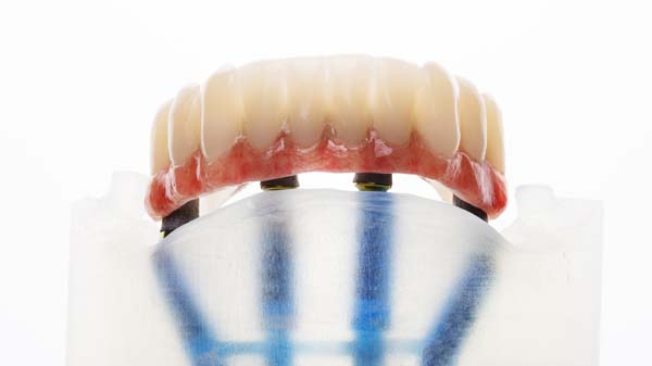 Comparing Implant Supported Dentures With Traditional Dentures